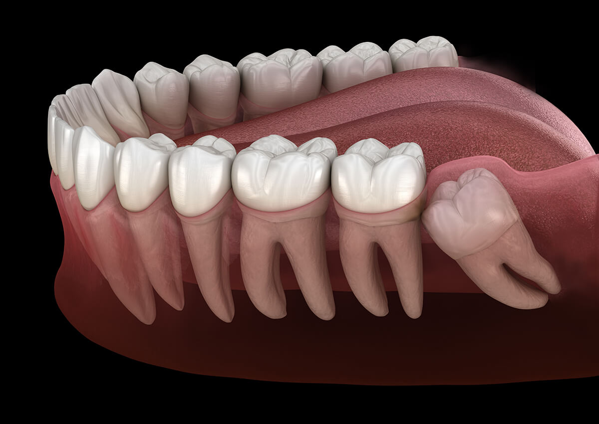 Wisdom teeth removal