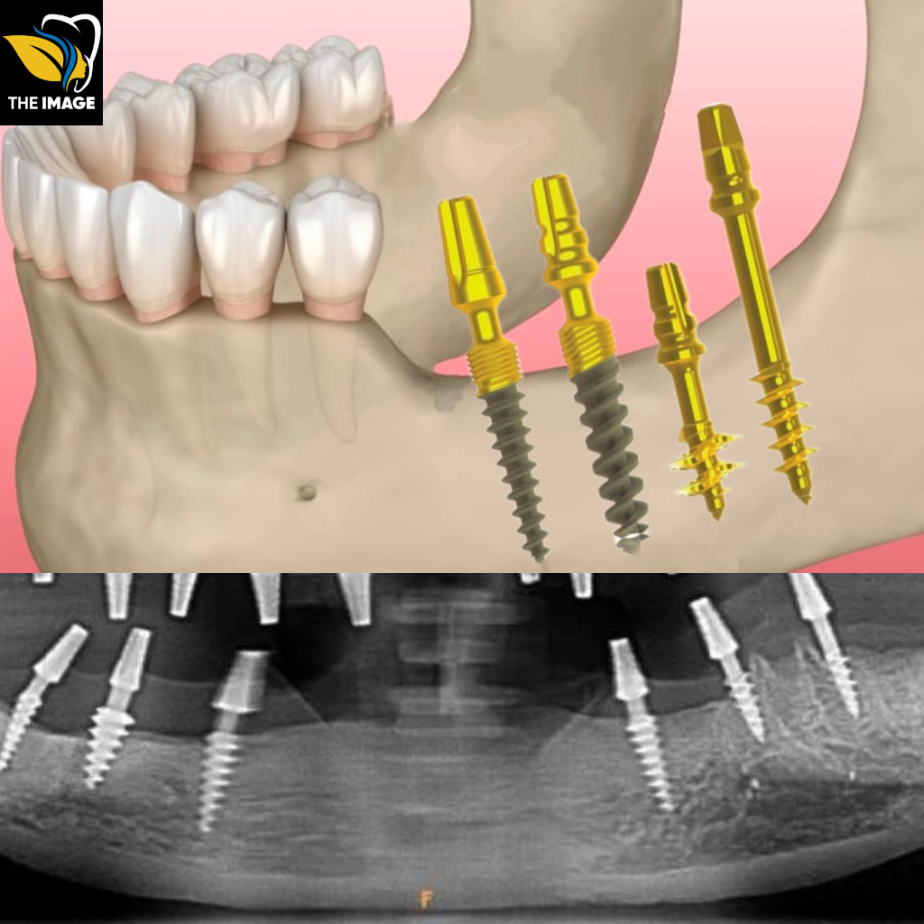 72-Hour Smile Makeover: Basal Implants Unveiled - The Image Hospital