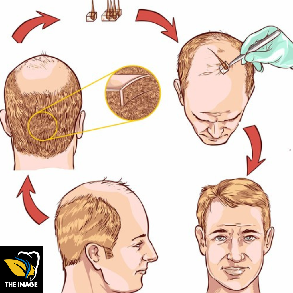 Effective Hair Transplant in Bangalore