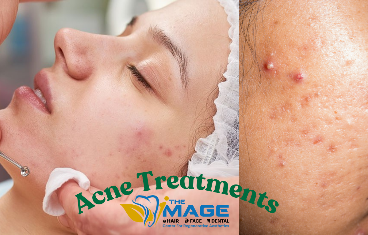 Acne-Treatments-in-Bangalore