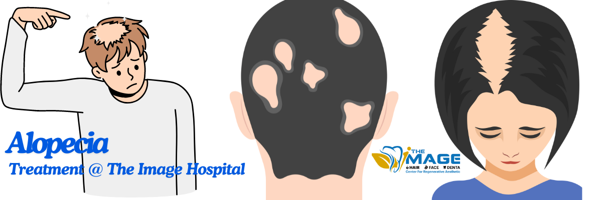 Alopecia-Treatment-in-Bangalore