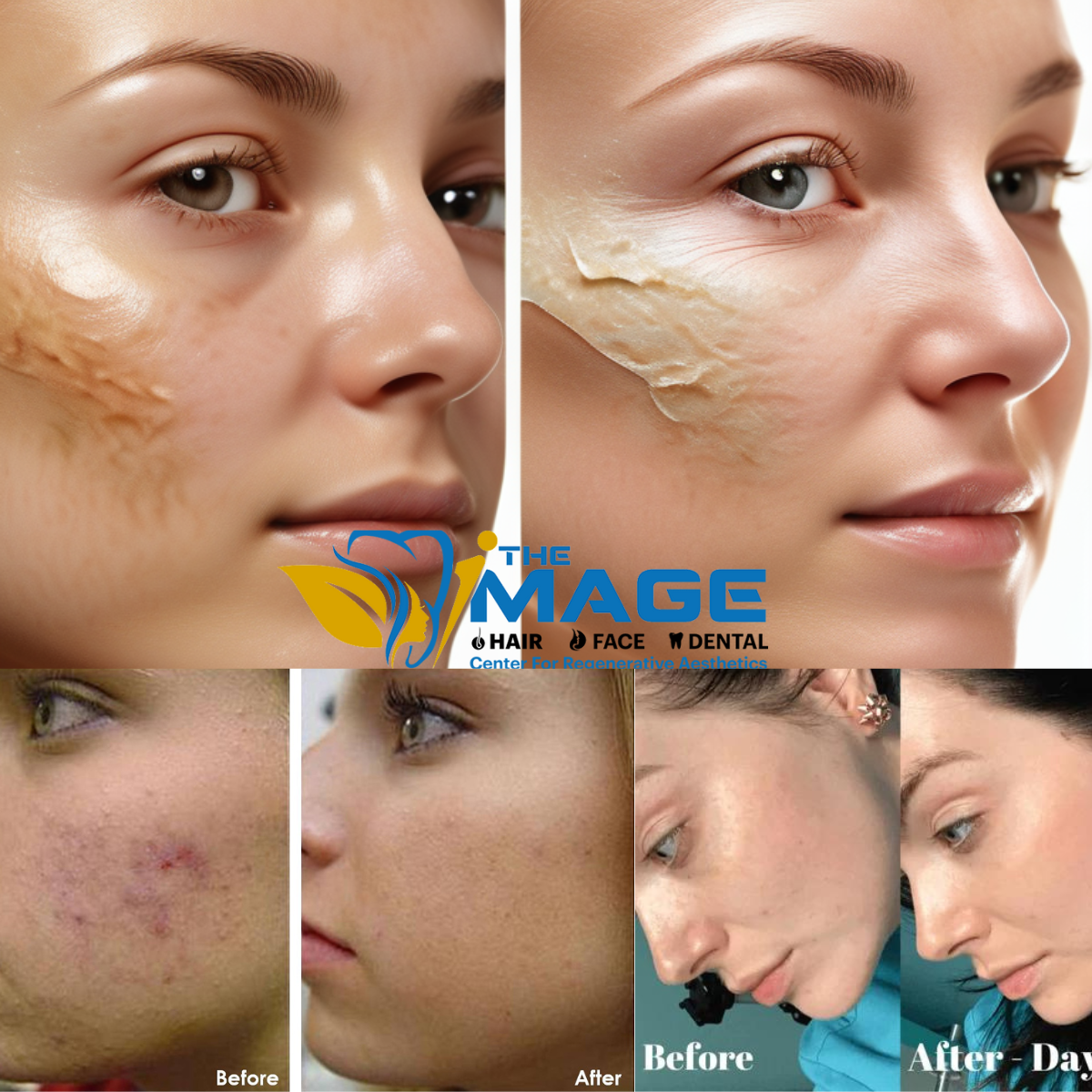Chemical Peels