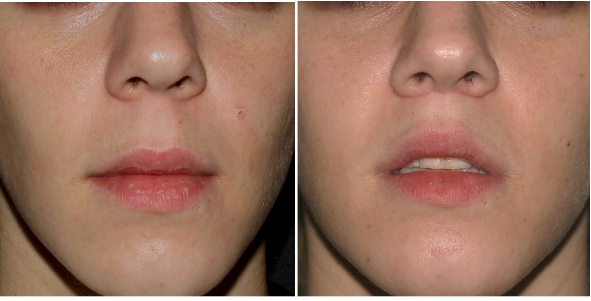 Lip Lift Surgery