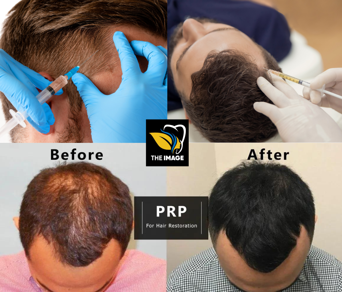 PRP-Hair-Fall-Treatment