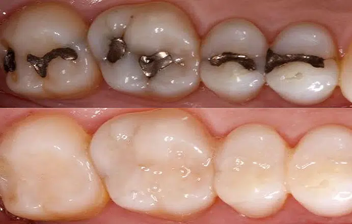 tooth-colored-composite-fillings