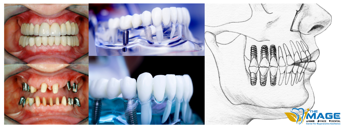 Full-Mouth-Dental-Implants