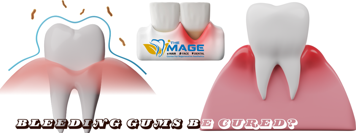Professional-Treatments-for-Bleeding-Gums