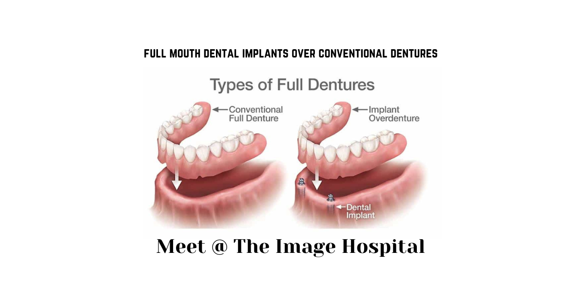 full mouth dental implants over conventional dentures