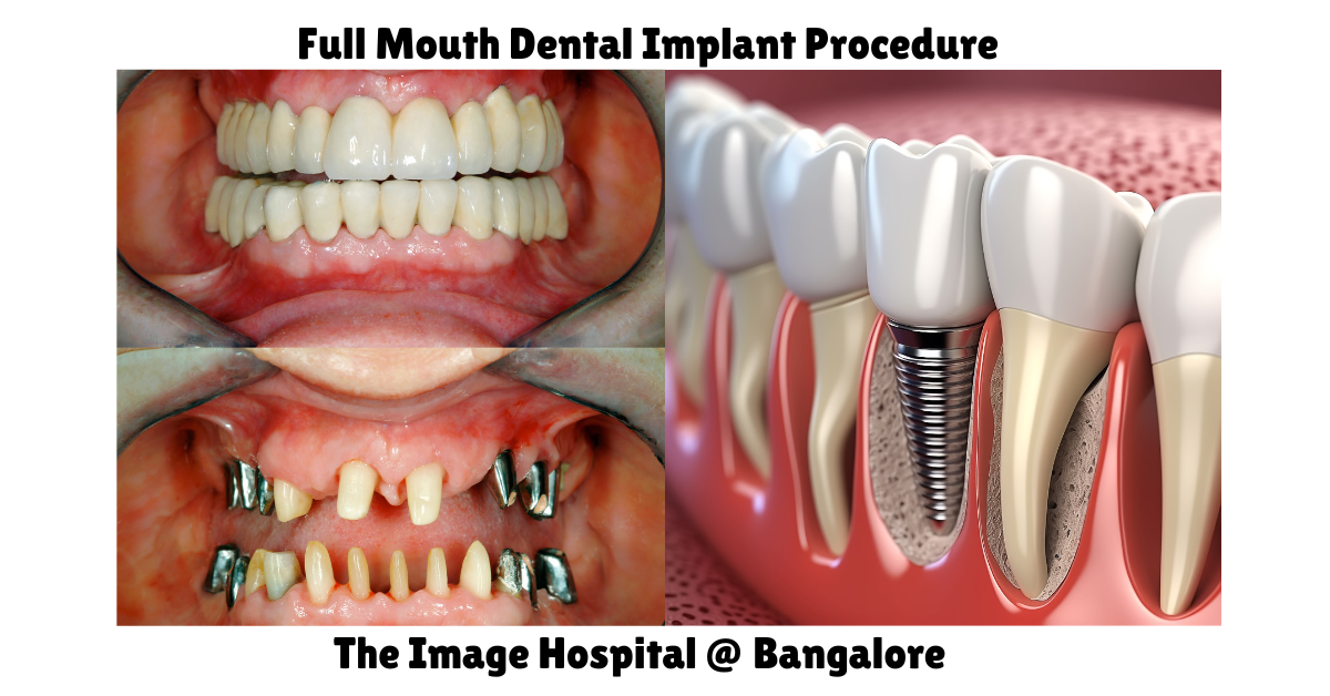 Full Mouth Dental Implant Procedure