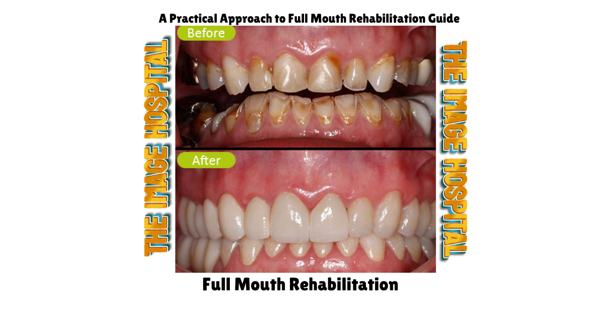 Full mouth rehabilitation -2024