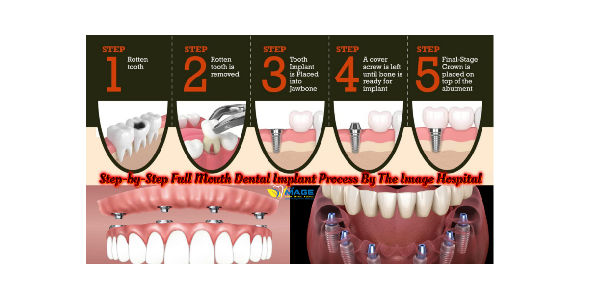 Step-by-Step Full Mouth Dental Implant Process