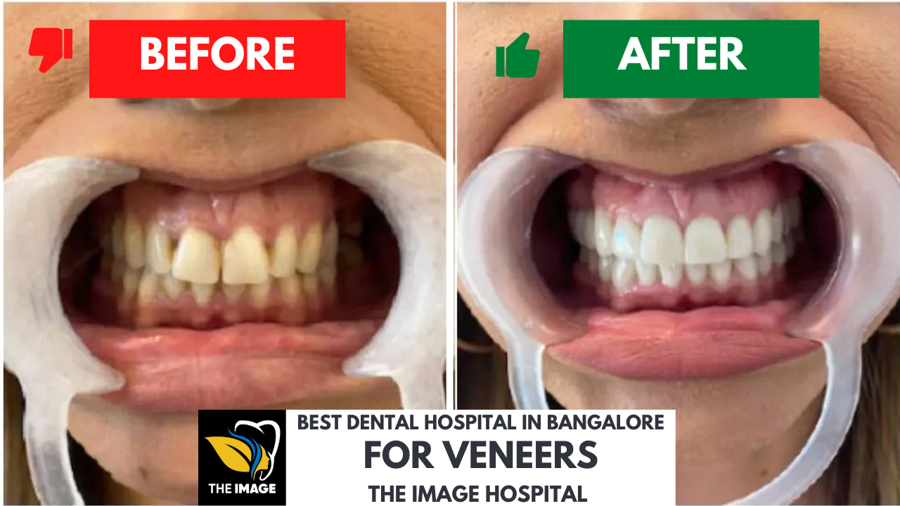 Dental Bonding or Veneers in Bangalore?