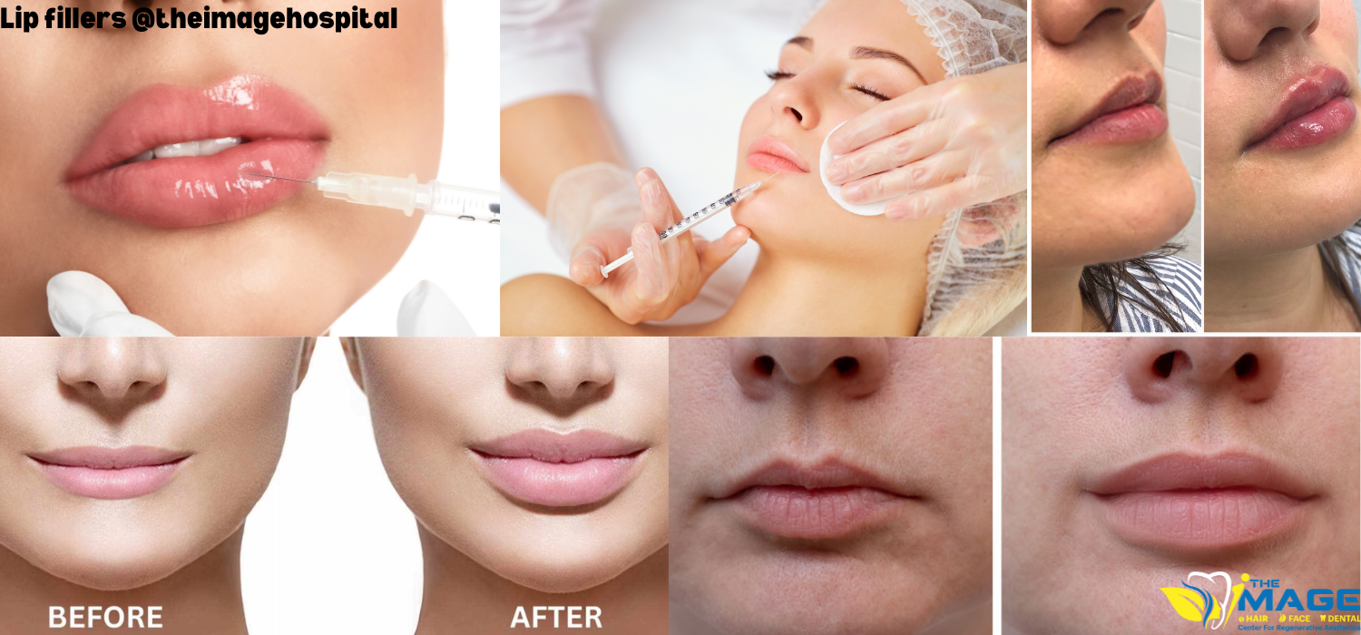 Lip fillers