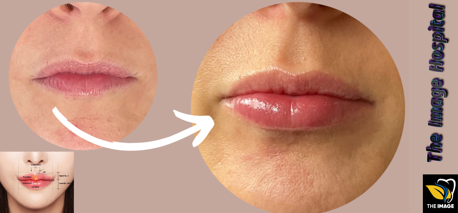 The Image Hospital fillers