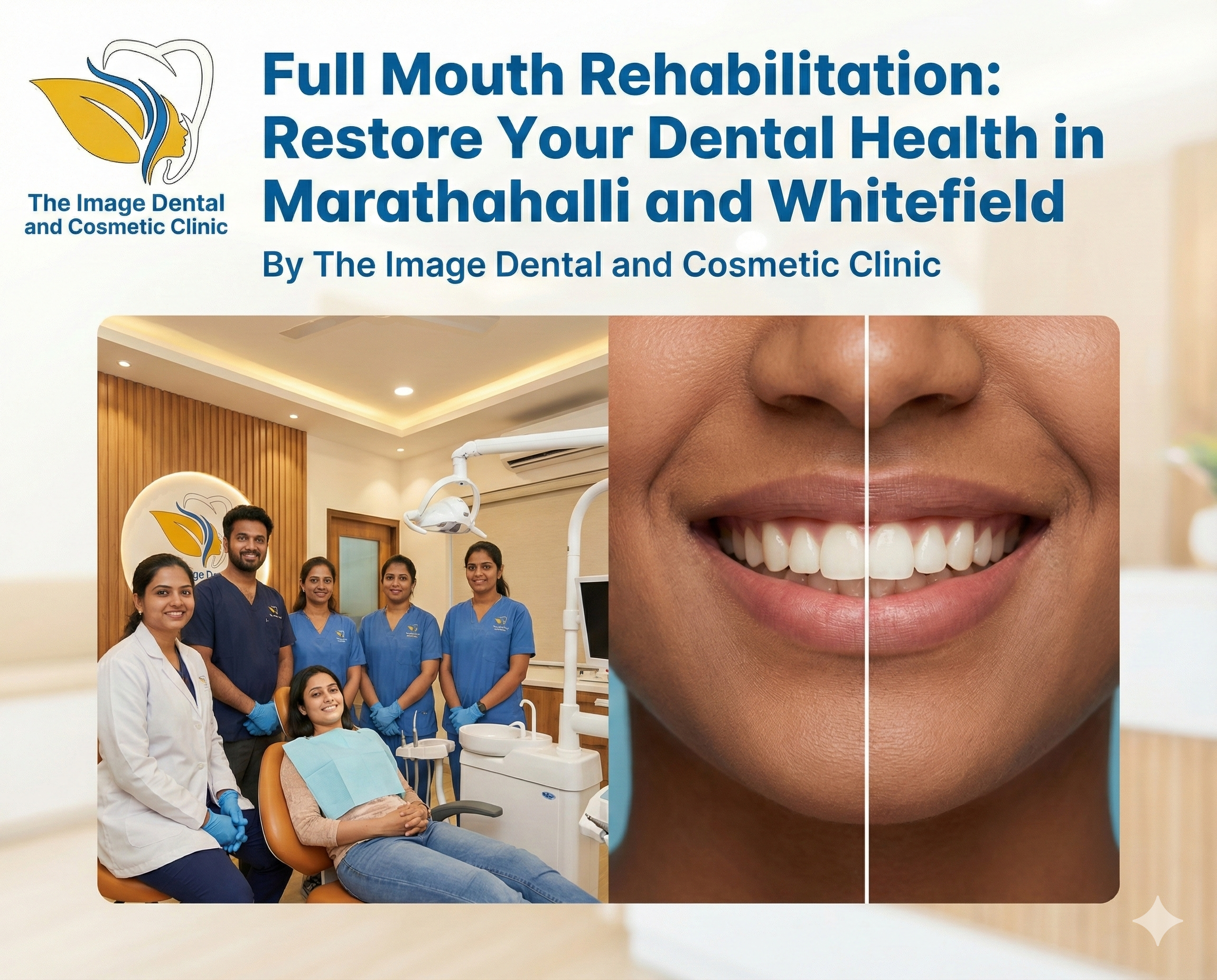 Full Mouth Rehabilitation - Dental Implant