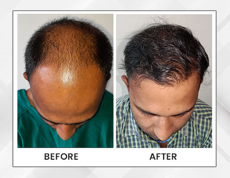 Hair Transplant Before and After