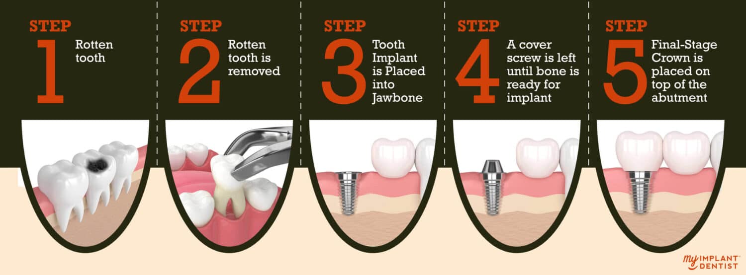 Dental-implant-procedure-step-by-step