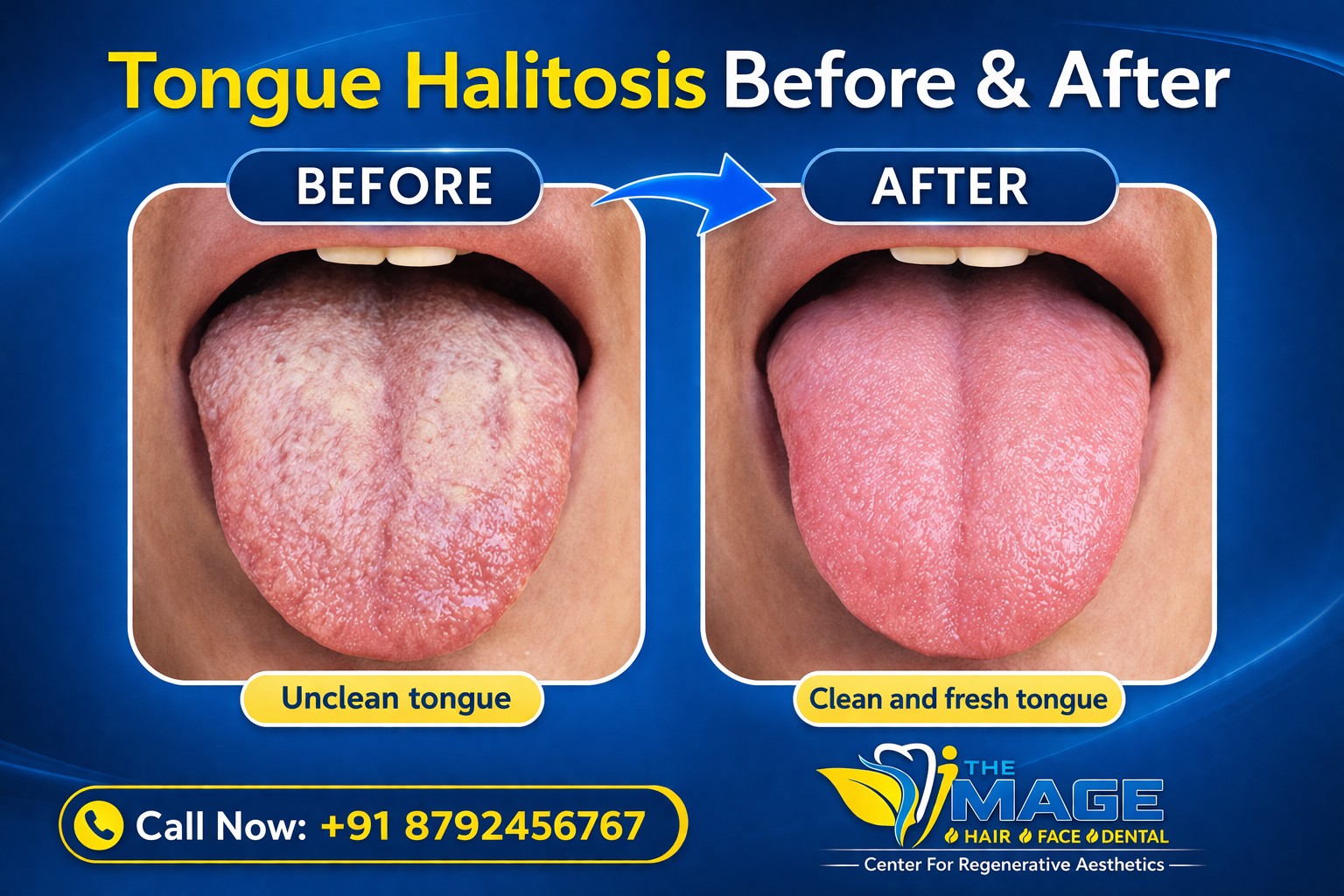 Cost of Halitosis Treatment in Bangalore